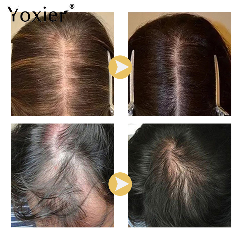 Intensive Wachstum Serum Verhi – Hair Care For Hair Loss Bewertung und Preis